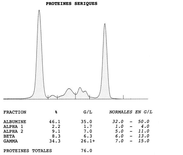 pic monoclonal gammaglobulines igg kappa - pic monoclonal quand s'inquiéter